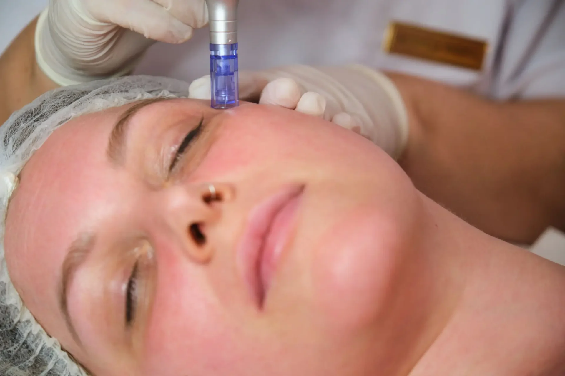 Close-up of a woman receiving a cosmetic facial injection.